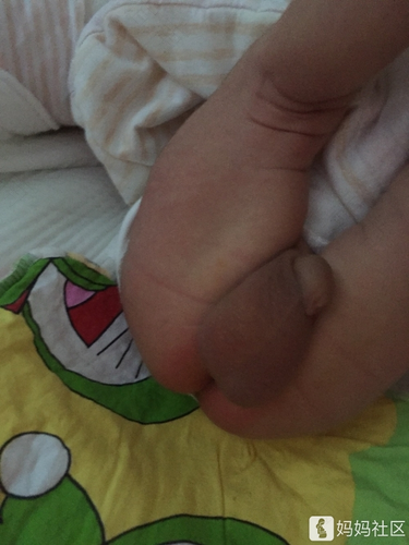 屁眼周围发红怎么回事 屁眼周围发红怎么回事