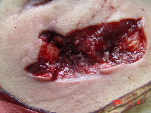 浆细胞乳腺炎能自愈吗 浆细胞乳腺炎能自愈吗