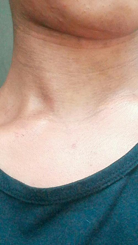 喉咙干痒有痰怎么办 喉咙干痒有痰怎么办