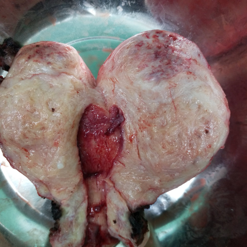 子宫结节和息肉是一回事吗 子宫结节和息肉是一回事吗