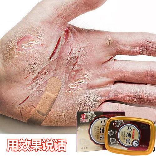 手皲裂了怎么办