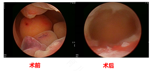 子宫息肉可以不做手术吗?