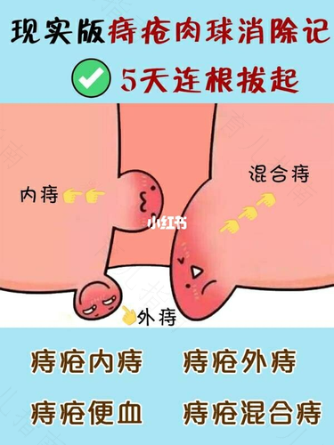 怎么知道痔疮严重不严重 怎么知道痔疮严重不严重