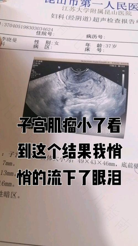 为什么会长子宫肌瘤和囊肿 为什么会长子宫肌瘤和囊肿