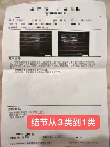 纤维瘤乳腺3类严重吗 纤维瘤乳腺3类严重吗