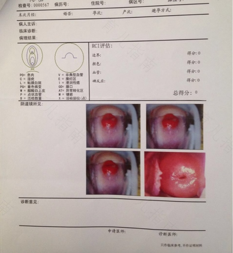 宫颈糜烂能引起腰疼痛吗 宫颈糜烂能引起腰疼痛吗