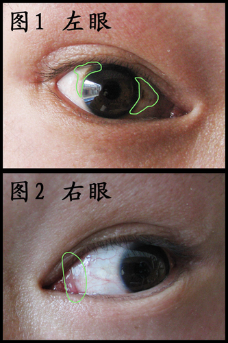 黄斑病怎么治疗好