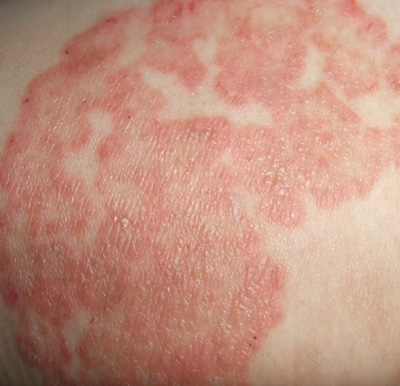 乳房湿疹症状有哪些 乳房湿疹症状有哪些