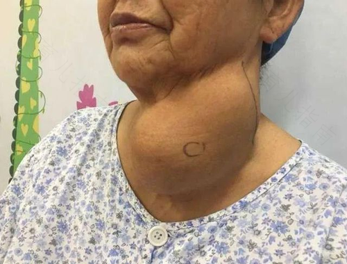 女性甲状腺瘤的症状有哪些 女性甲状腺瘤的症状有哪些