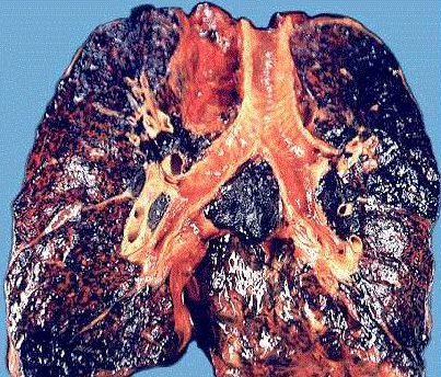 间质性肺炎的晚期是什么症状 间质性肺炎的晚期是什么症状