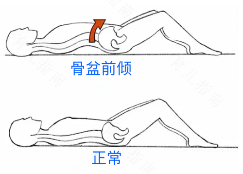 盆骨前倾睡硬板床会改善吗 盆骨前倾睡硬板床会改善吗