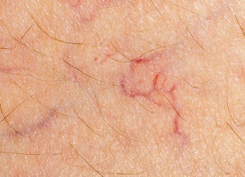 身上起小红点怎么回事啊 身上起小红点怎么回事啊