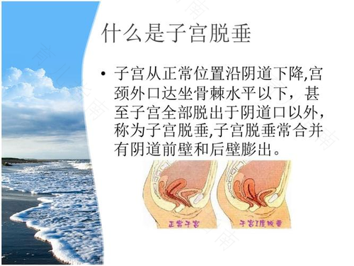 顺产子宫脱垂有什么症状 顺产子宫脱垂有什么症状