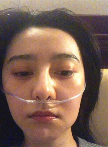 牙齿痛脸肿了怎么消肿 牙齿痛脸肿了怎么消肿