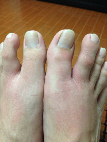 脚的大拇指肿了怎么办? 脚的大拇指肿了怎么办?