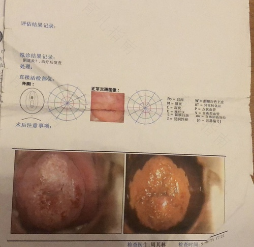 宫颈活检是什么意思是hpv检查吗