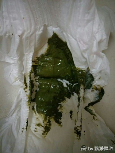 大便黑绿是怎么回事儿