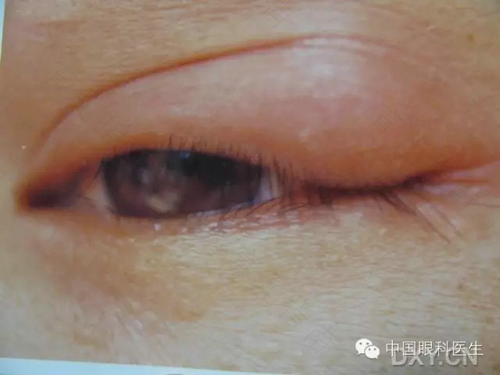 泪腺管发炎怎么办 泪腺管发炎怎么办