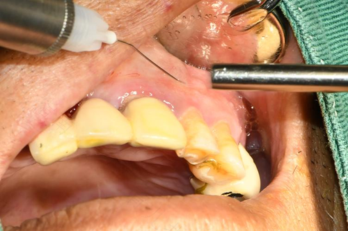 拔牙打麻药痛吗 拔牙打麻药痛吗