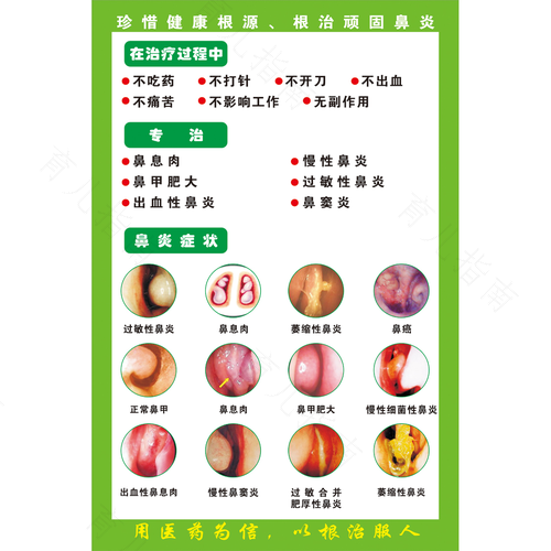得了鼻炎有哪些症状
