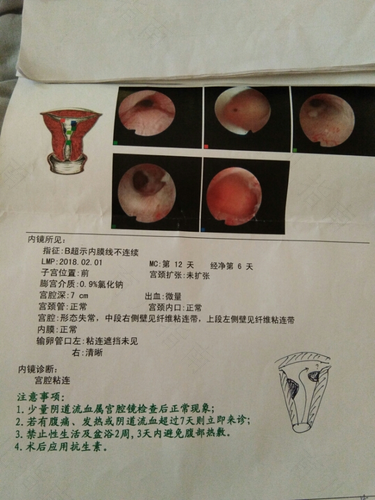 宫腔镜什么时候检查最好 宫腔镜什么时候检查最好
