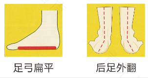 扁平足足外翻能治好吗 扁平足足外翻能治好吗
