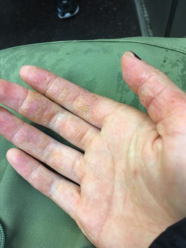 手上有湿疹会传染吗 手上有湿疹会传染吗