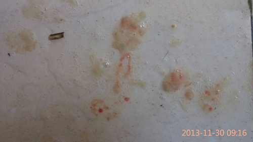 感冒咳嗽带血是怎么回事 感冒咳嗽带血是怎么回事