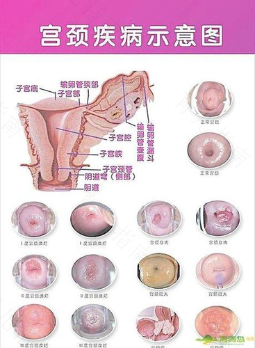 宫颈管粘膜炎要怎么治疗