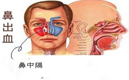 鼻衄怎么治疗
