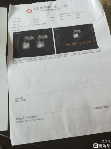 产后宫颈管积液什么意思 产后宫颈管积液什么意思