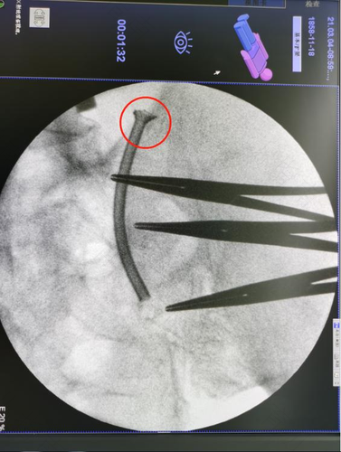 尿道管变粗了怎么回事 尿道管变粗了怎么回事
