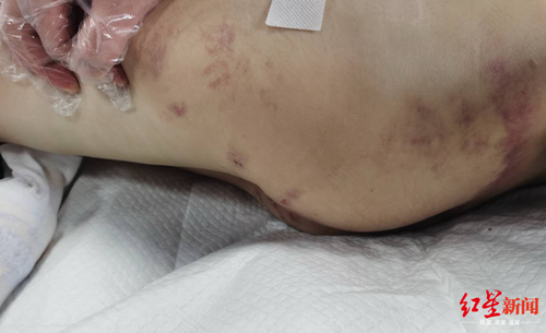 软组织的损伤怎么办 软组织的损伤怎么办