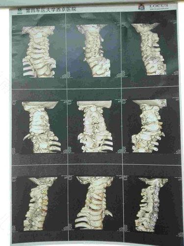 大排畸脊柱看不清是啥原因 大排畸脊柱看不清是啥原因