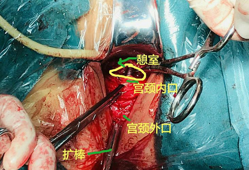 疤痕憩室是什么意思 疤痕憩室是什么意思
