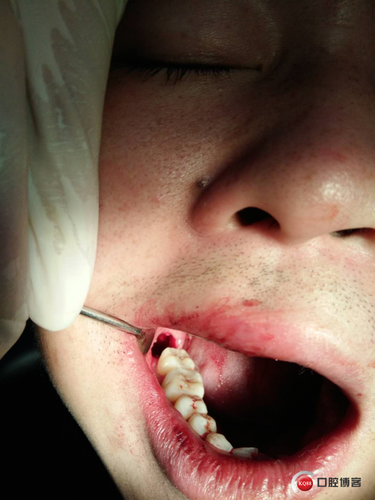 刚拔完牙神经还疼怎么办