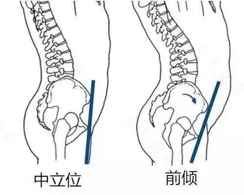 骨盆窄是紧的意思吗 骨盆窄是紧的意思吗