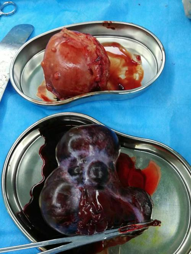 卵巢囊肿手术需要切除子宫吗