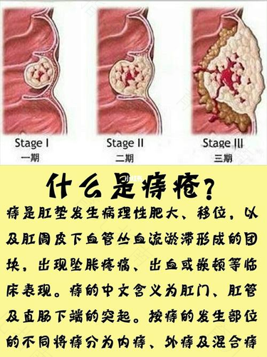 痔疮肉球痒痒怎么回事