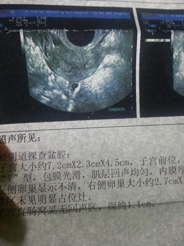 单角子宫怎么检查出来 单角子宫怎么检查出来