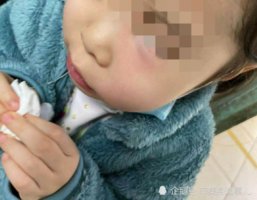 牙疼半边脸肿了怎么办 牙疼半边脸肿了怎么办