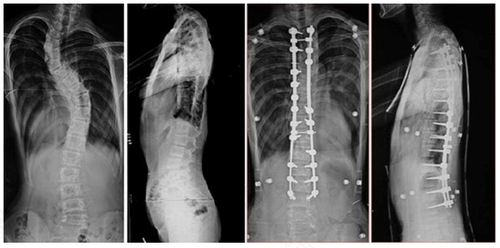 胎儿脊柱畸形是什么导致的