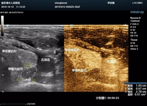 脏器声学造影检查什么部位 脏器声学造影检查什么部位