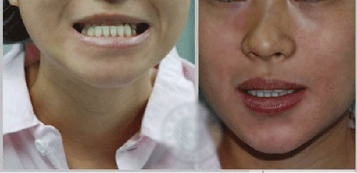 孩子兜兜齿怎么办 孩子兜兜齿怎么办