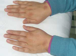 缺钙会手指关节疼吗 缺钙会手指关节疼吗