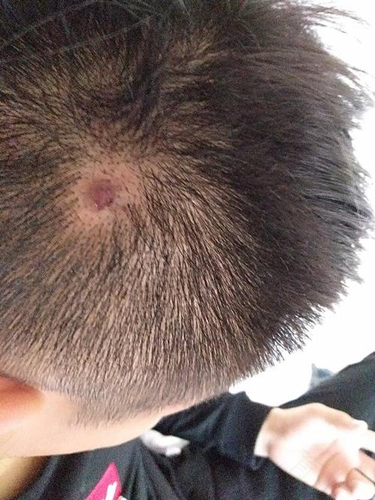 头顶中间疼是怎么回事