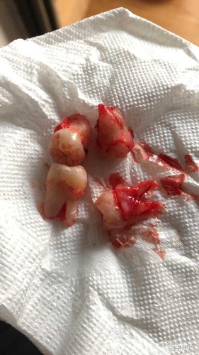 拔完智齿后很痛怎么办 拔完智齿后很痛怎么办