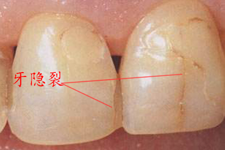 牙齿突然冷热痛怎么办 牙齿突然冷热痛怎么办