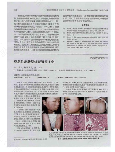 亚急性红斑狼疮严重吗 亚急性红斑狼疮严重吗