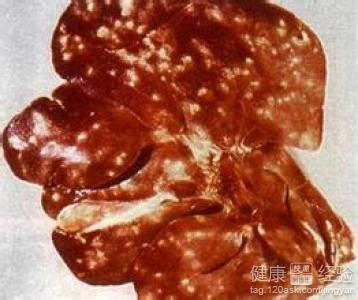 肝吸虫三种类型的不同症状